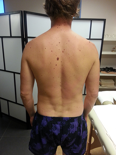 Stav zad po 1 t�dnu - p�i kontrole